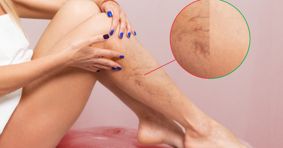 Why Early Vascular Screenings Can Save Lives